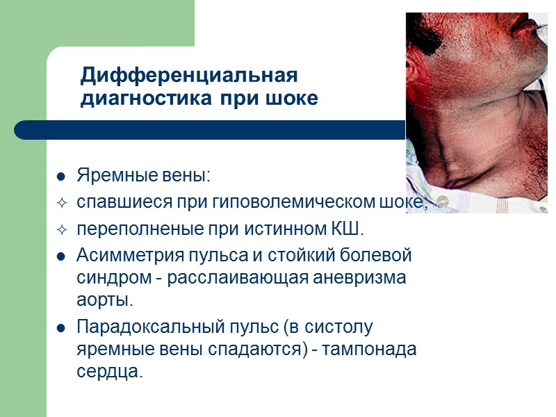 Дифференциальная  диагностика при шоке  Яремные вены: спавшиеся при гиповолемическом шоке;  переполненые